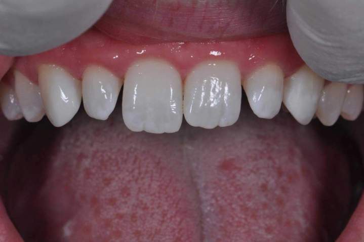 Peg Laterals Melbourne - Before