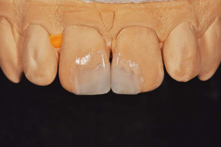 Transforming Smiles with Expertly Crafted Ceramic Veneers.