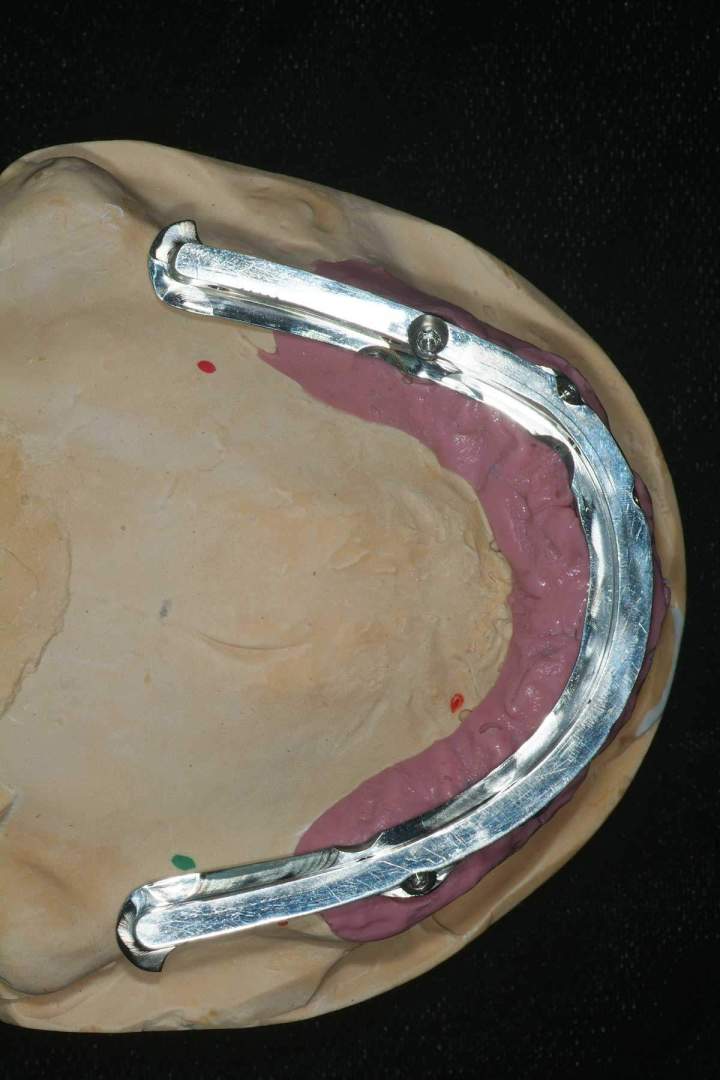 Nexus Plus Full Bridge Melbourne