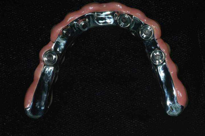 Nexus Plus Full Bridge Melbourne