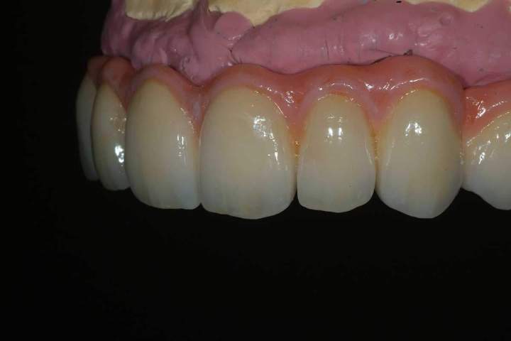 Nexus Plus Full Bridge Melbourne