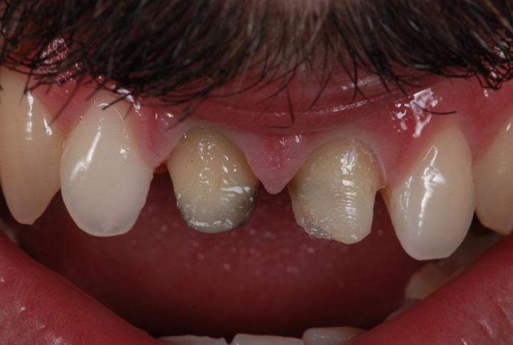 E-Max Melbourne - Before