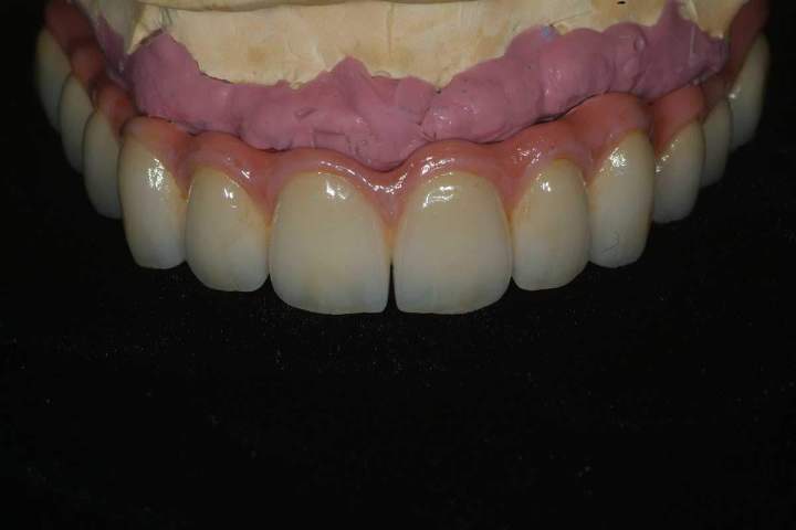 Nexus Plus Full Bridge Melbourne