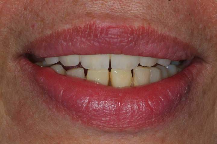 Nexus Plus Full Bridge Melbourne