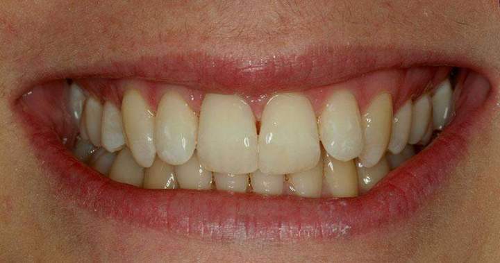 Veneer Melbourne - After