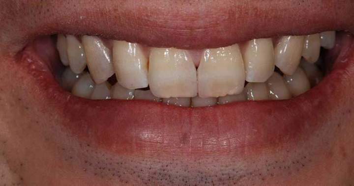 Veneer Melbourne - After