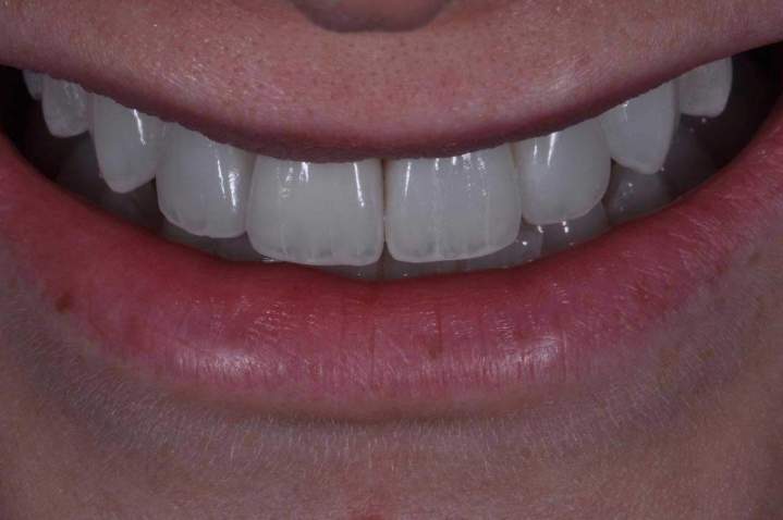 Veneers Melbourne - After