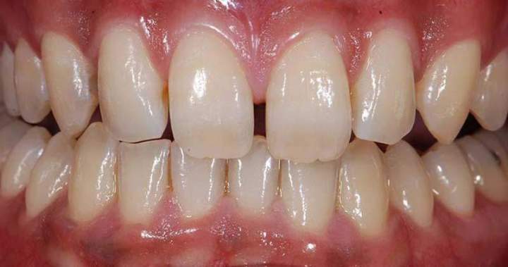 Veneer Melbourne - Before