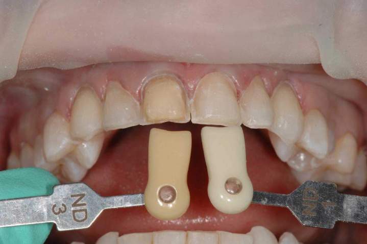 Veneers Melbourne - Preparation