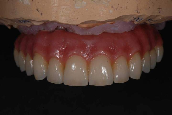 PFM Bridge Melbourne - After