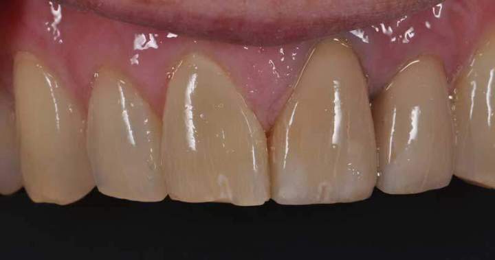 Zirconia Melbourne - After