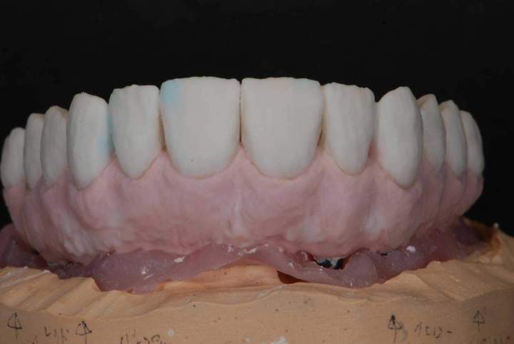 PFM Bridge Melbourne - Ceramic