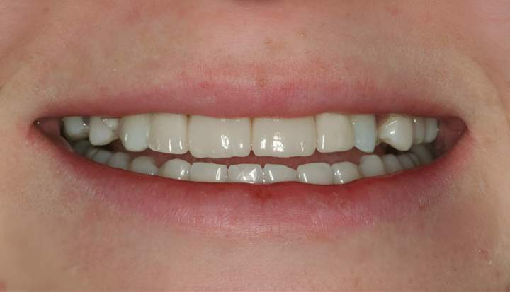 After Picsart AiImageEnhancer