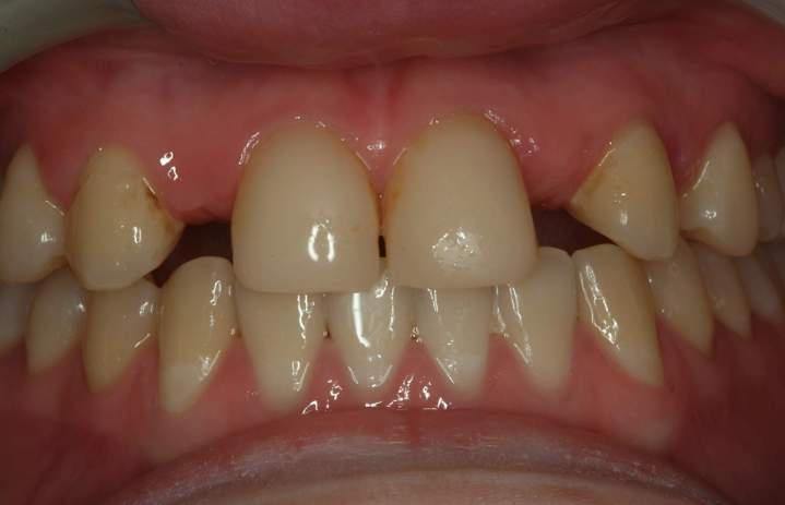 Before Picsart AiImageEnhancer