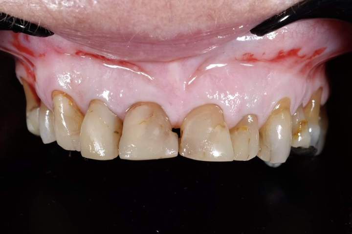 E-Max Melbourne - Before