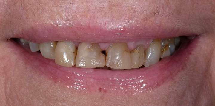 E-Max Melbourne - Before