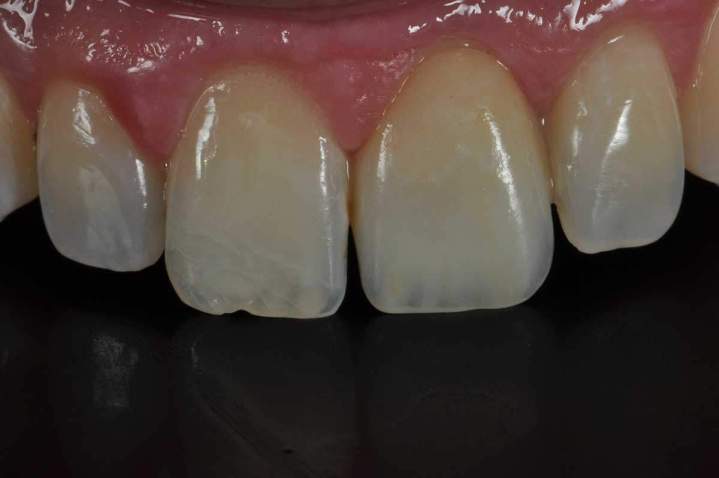 After - Ceramic Crowns Melbourne