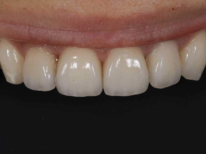 Ceramic Crowns Melbourne