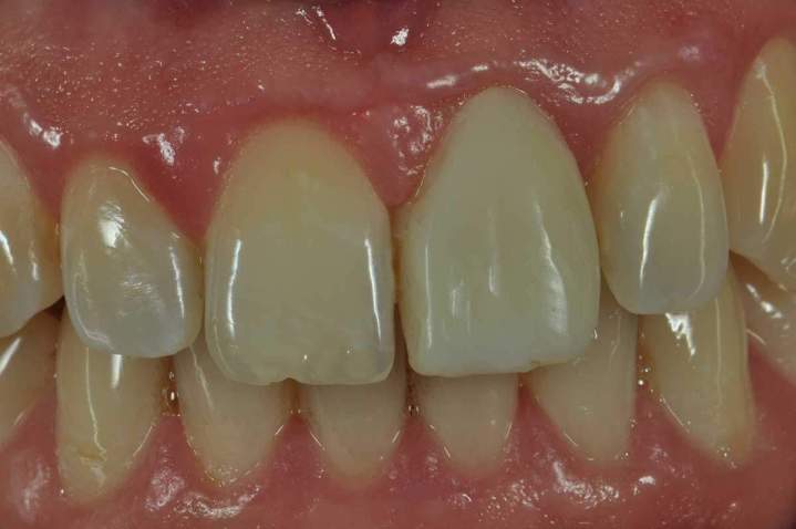 Before - Ceramic Crowns Melbourne