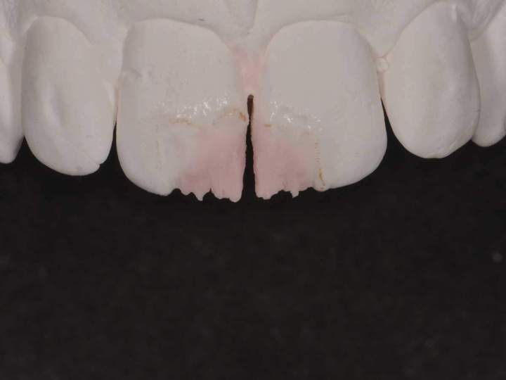 Ceramic Veneers Melbourne