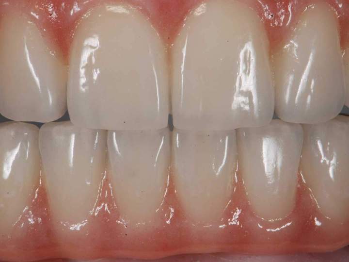 Dental Implants Melbourne