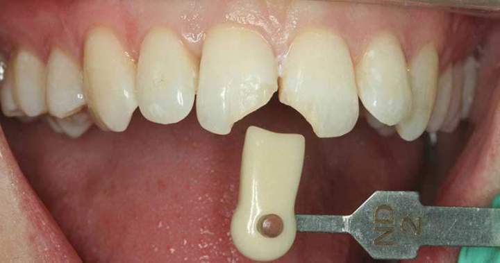 Veneer Melbourne - Before