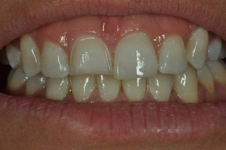 E-Max Melbourne - Before