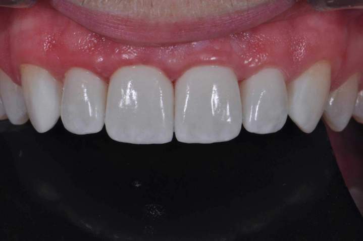 Peg Laterals Melbourne - After