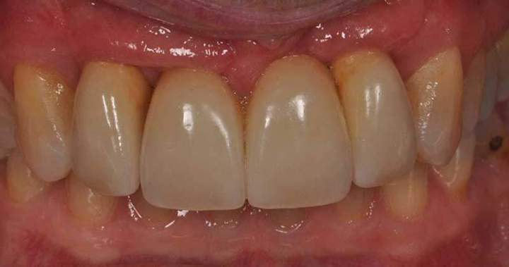 Implants Melbourne - After