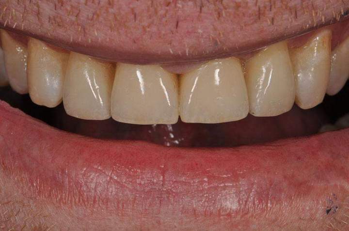 PFM Melbourne - After