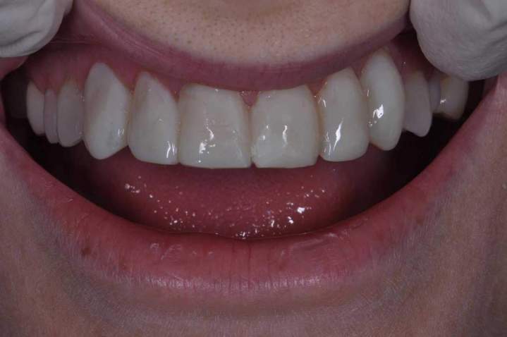 Veneers Melbourne - Temporary