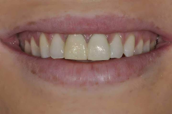 E-Max Melbourne - Before