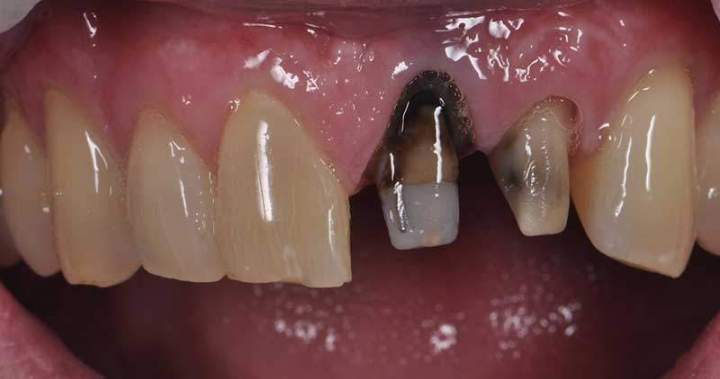 Zirconia Melbourne - Before