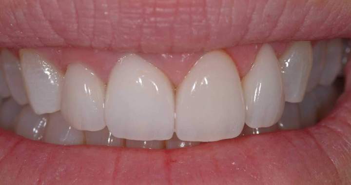 After - Zirconia Melbourne 