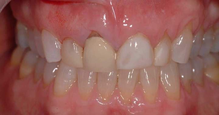 Before - Zirconia Melbourne 