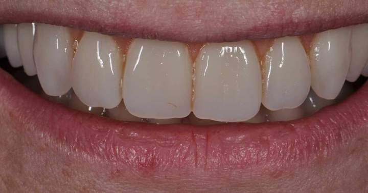 After - Implants Melbourne