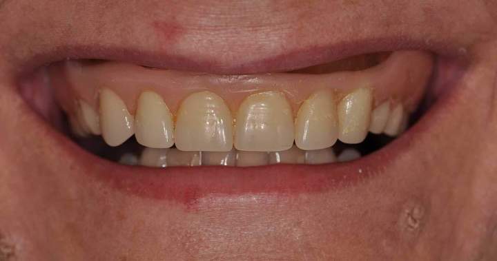 Before - Implants Melbourne