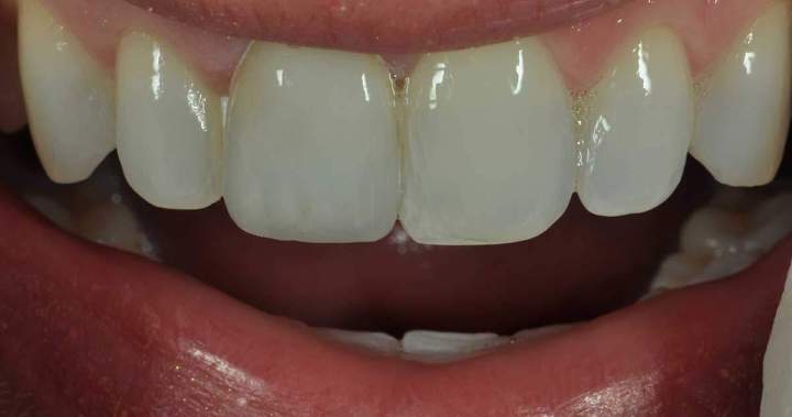 After - Zirconia Melbourne 