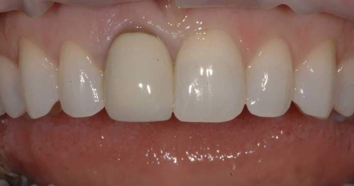 before - Zirconia Melbourne 